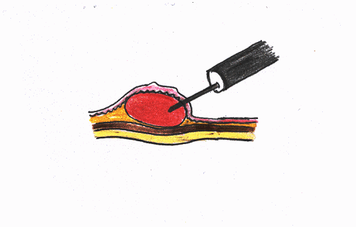 ���Ȍ��t��S�����ɒ���(�u���b�h�p�b�`�d�l�q�Ƃ����咰�|���[�v�̓������I�؏����@�j