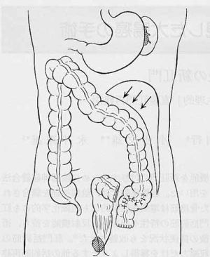 結腸を肛門部まで届かせるため、結腸を遊離する。
