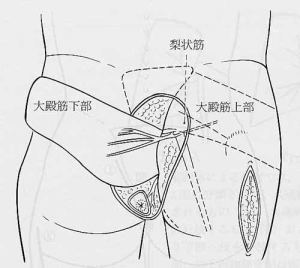 �V����p�B��a�؉����𔽓]�������Ƃ���B